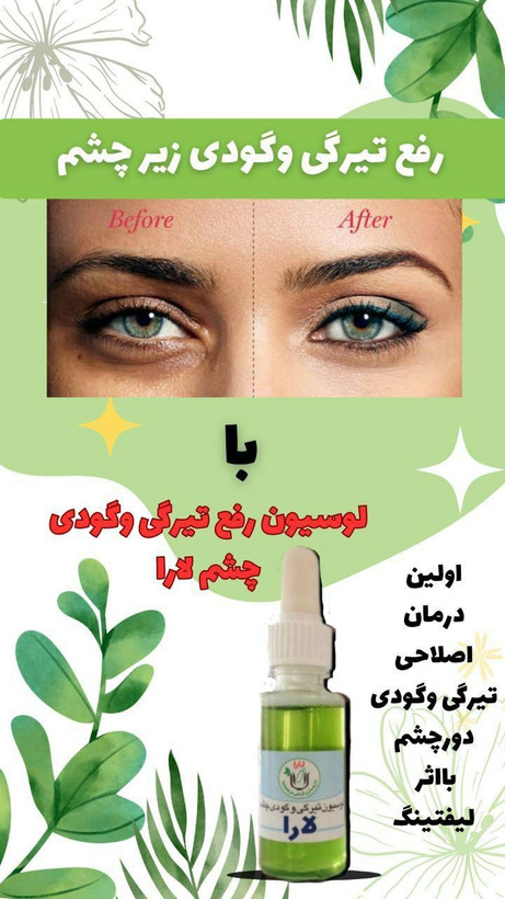 لوسیون رفع تیرگی و گودی زیرچشم صددرصد گیاهی ،جوابدهی بی نظیر