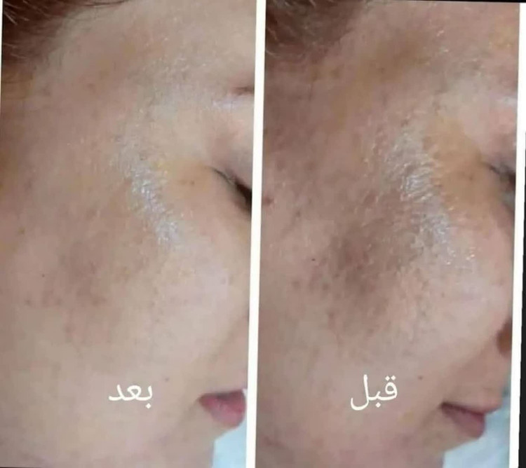 کرم دست ساز دکتر طب سنتی ضدلک و روشن کننده فوق قوی پوست سفید کننده عالی
