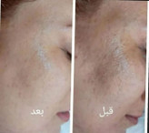 کرم ضدلک و روشن کننده فوق قوی vip پلاس کره ای(صددرصد اصلی و تضمینی ) بی نظیر و بی رقیب کاملا پلمپ و بهداشتی