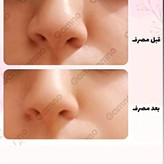 کوچک کننده بینی گام اصلی