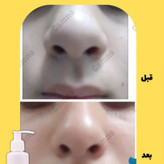 کوچک کننده بینی Go مخصوص بینی های گوشتی(جواب دهی عالی)