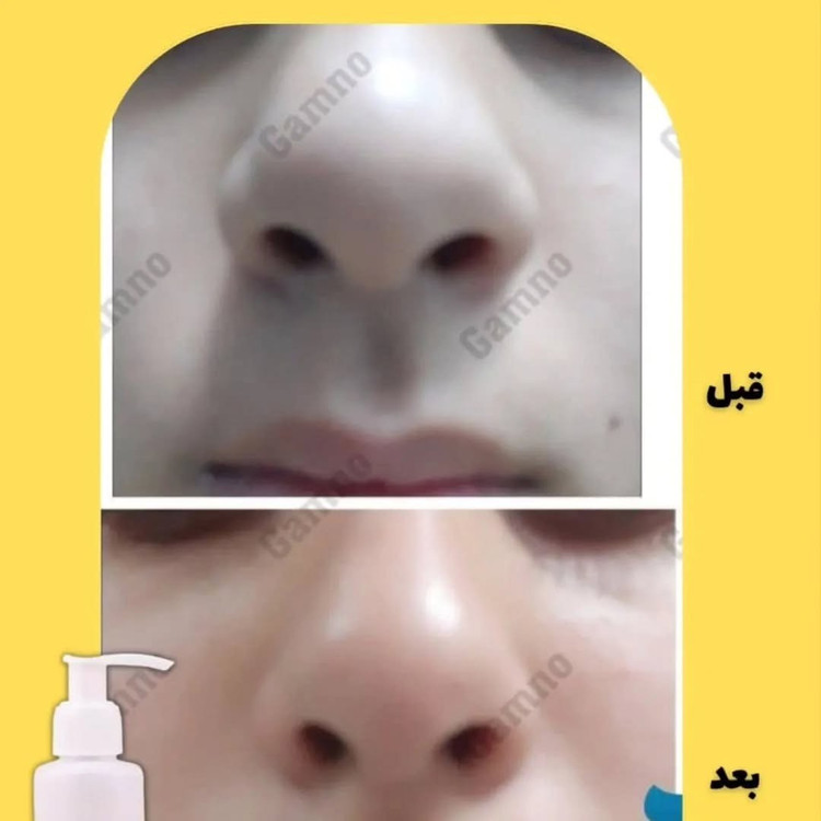 کوچک کننده بینی Go مخصوص بینی های گوشتی(جواب دهی عالی)