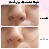 کوچک کننده بینی Go مخصوص بینی های گوشتی(جواب دهی عالی)