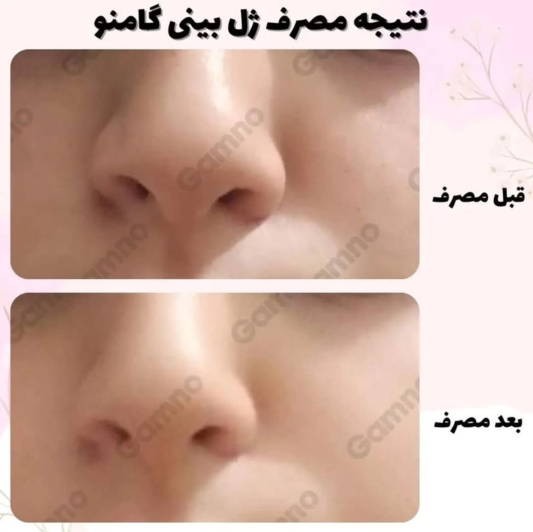 کوچک کننده بینی Go مخصوص بینی های گوشتی(جواب دهی عالی)