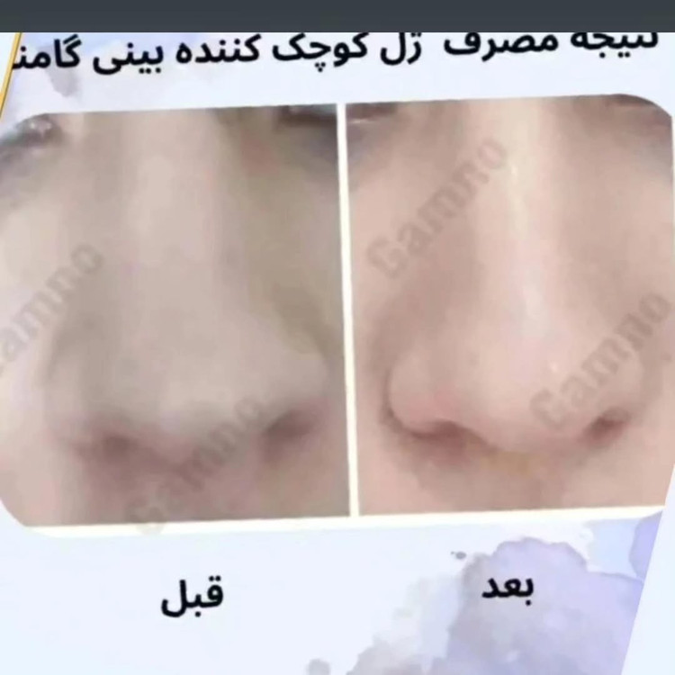 کوچک کننده بینی Go مخصوص بینی های گوشتی(جواب دهی عالی)