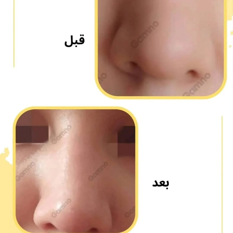 کوچک کننده بینی Go مخصوص بینی های گوشتی(جواب دهی عالی)